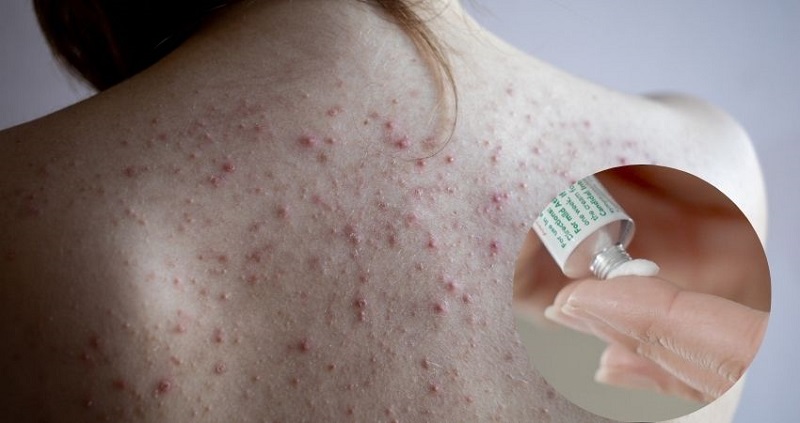 bơi thuốc trị viêm nang lông lưng