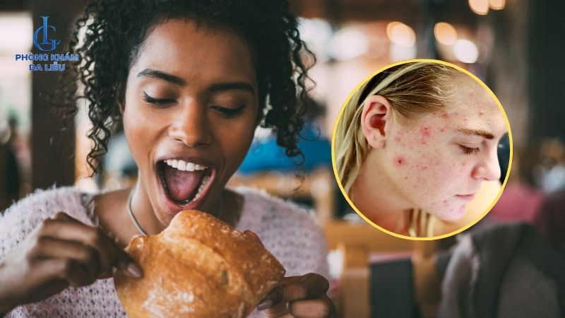 Ăn bánh mì có bị nổi mụn không