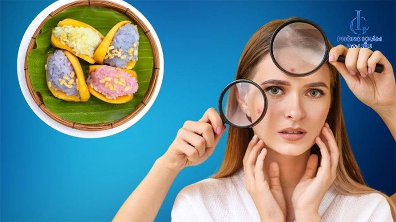 Ăn xôi có nổi mụn không?