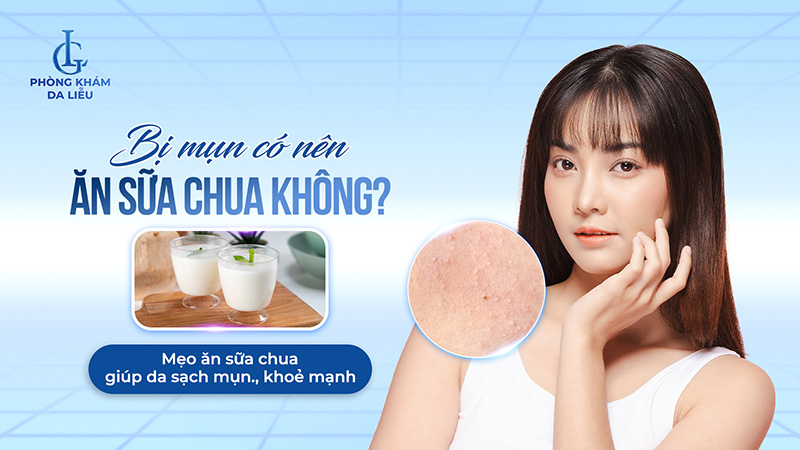 Bị mụn có nên ăn sữa chua không