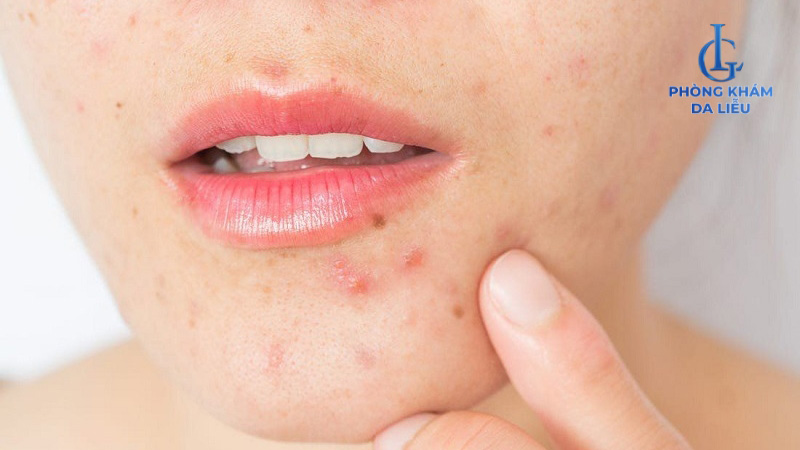 Mụn nội tiết quanh cằm