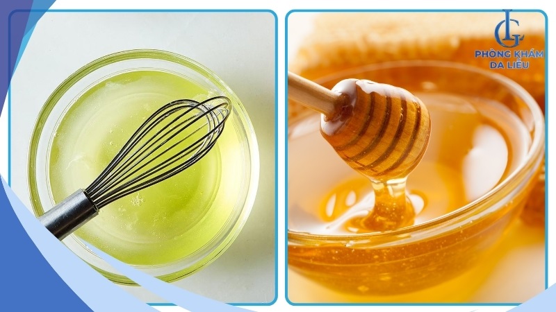 Trị mụn bằng lòng trắng trứng gà và mật ong