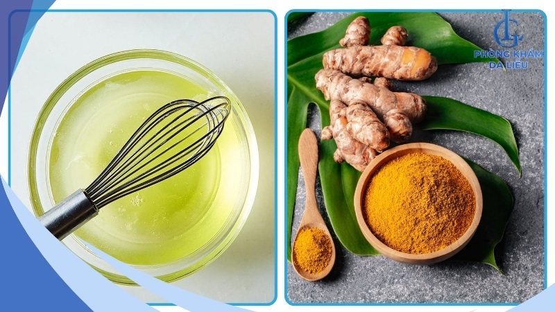 Cách trị mụn bằng nghệ và lòng trắng trứng gà