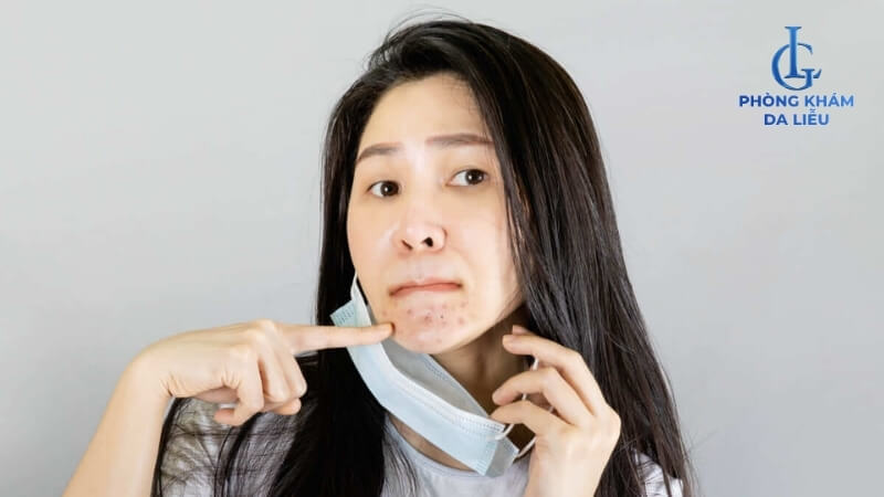 Nổi mụn ở cằm khi đeo khẩu trang quá lâu