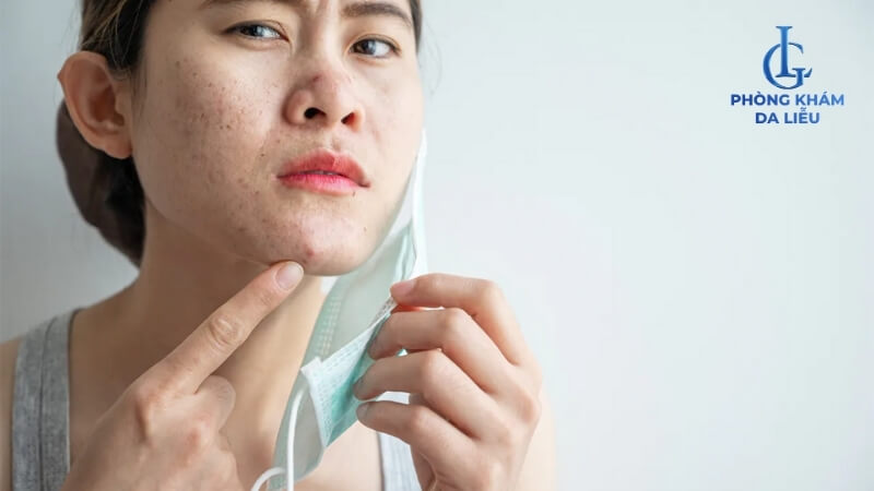 Đeo khẩu trang bị mụn do kích ứng