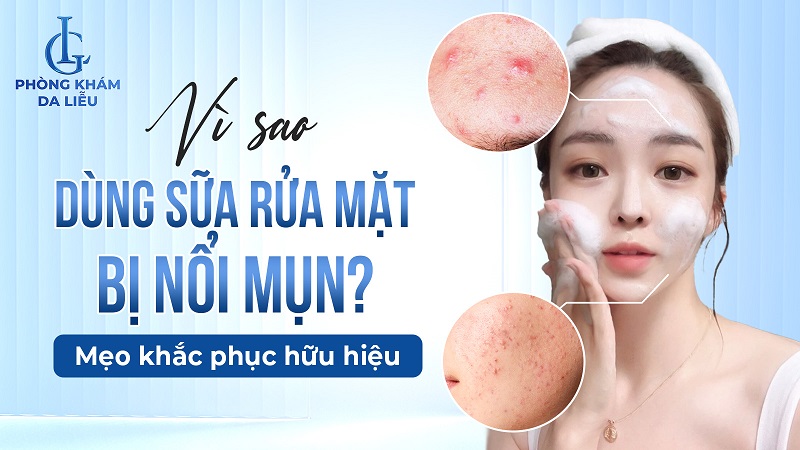 Dùng sữa rửa mặt bị nổi mụn
