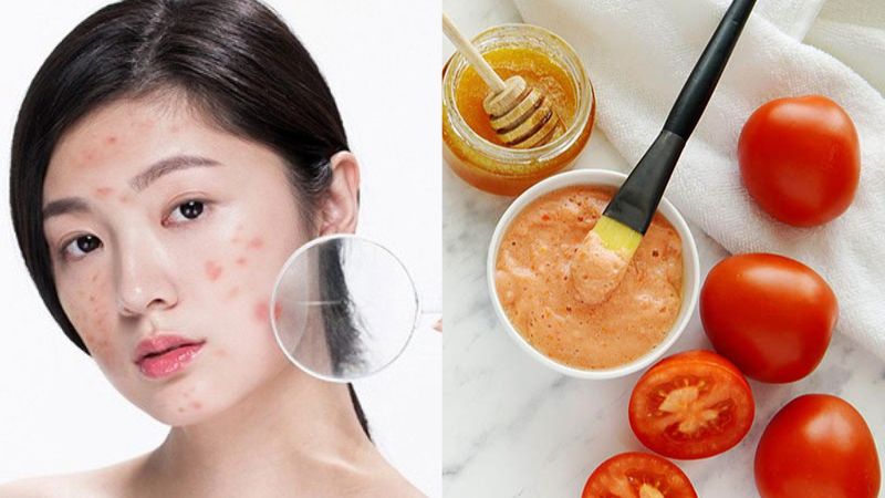cách trị mụn bằng mật ong cho da dầu