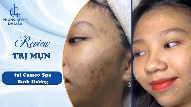 địa chỉ trị mụn Bình Dương Cameo Spa