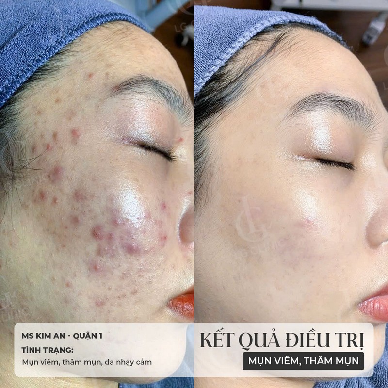 hình ảnh trị mụn trước và sau