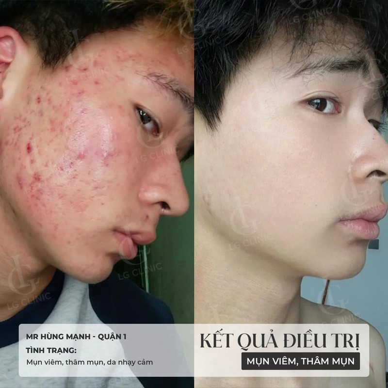 hình trước và sau trị mụn mặt 2