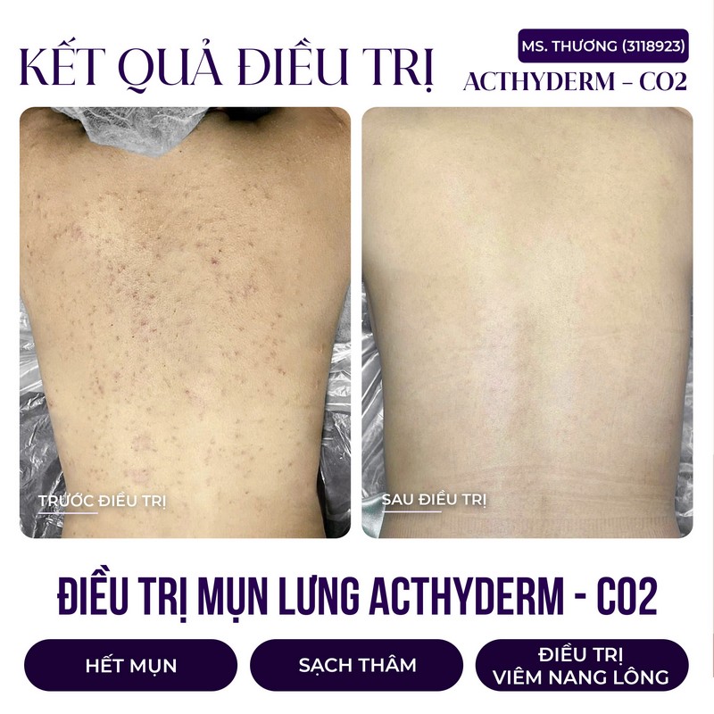 hình trước và sau trị mụn lưng