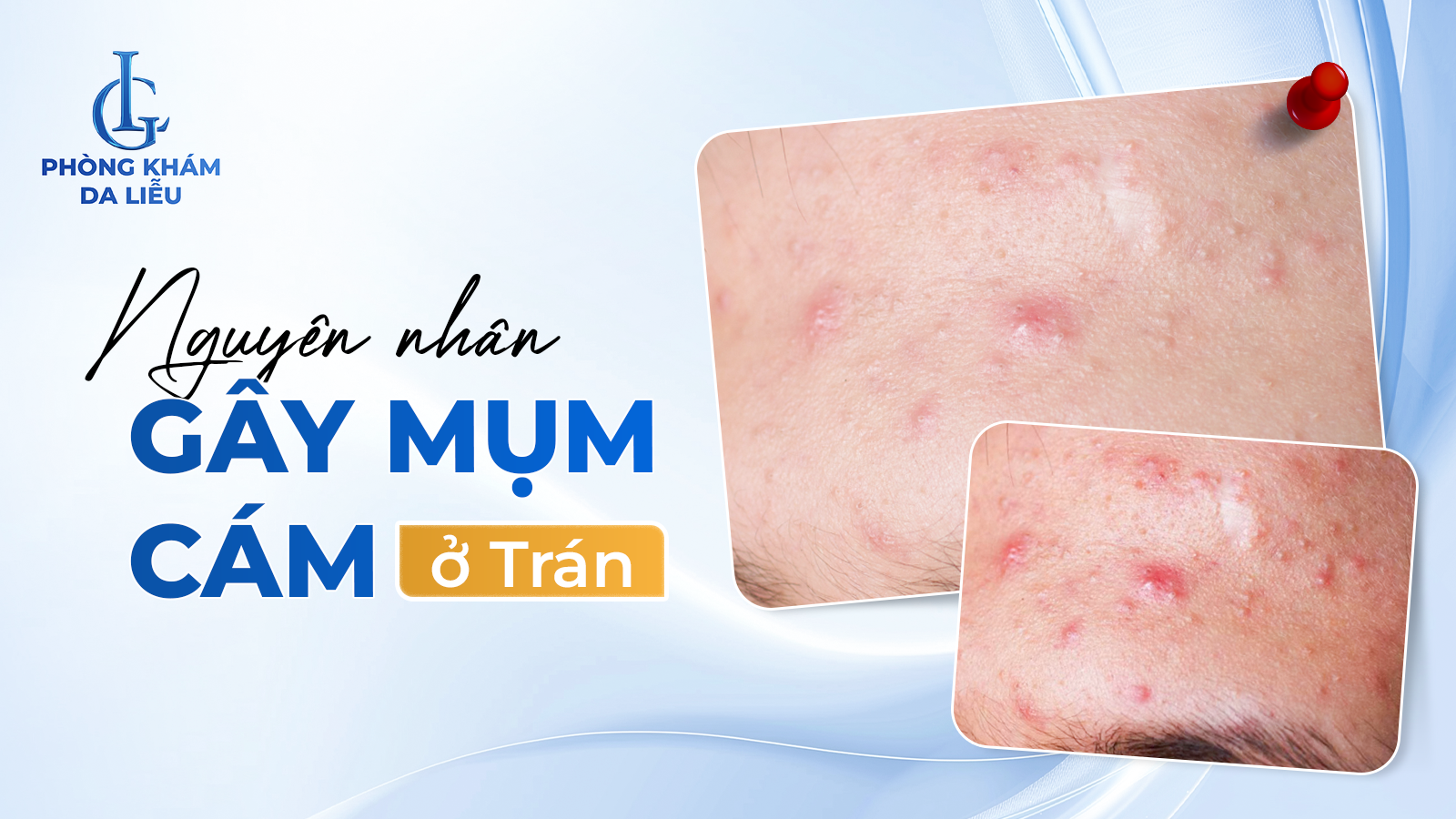 Mụn cám ở trán