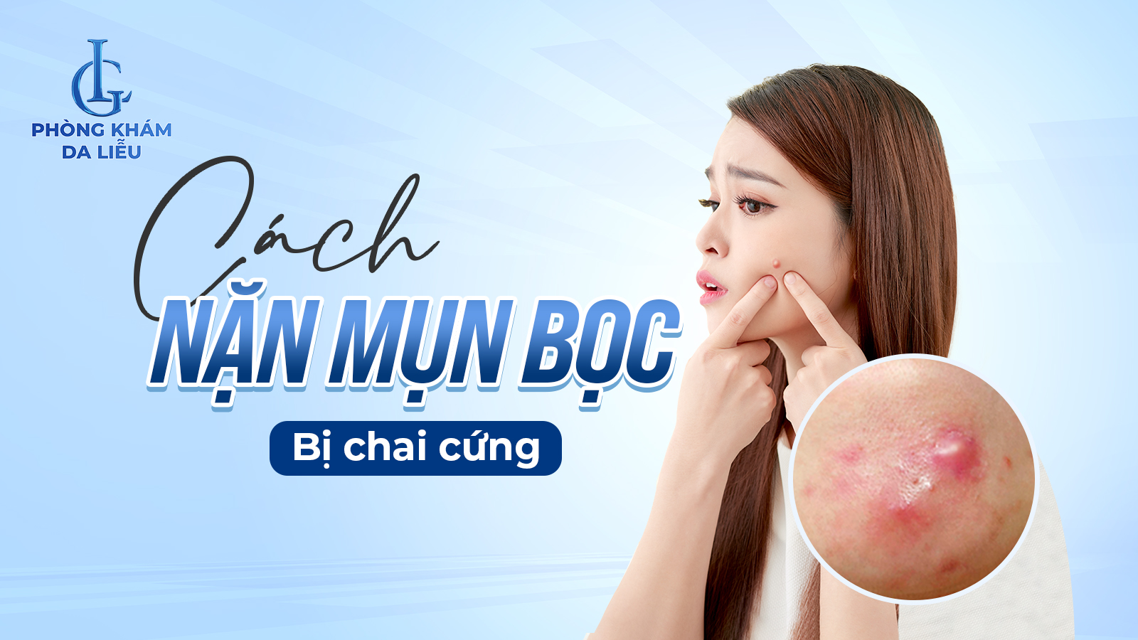 Cách nặn mụn bọc bị chai cứng