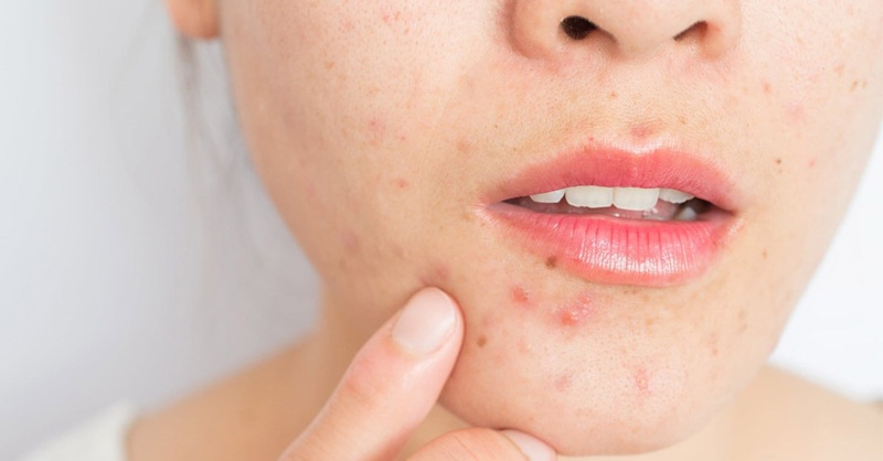 Bị mụn có nên ăn thịt gà không