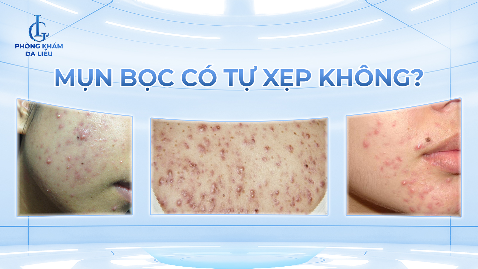 mụn bọc có tự xẹp không