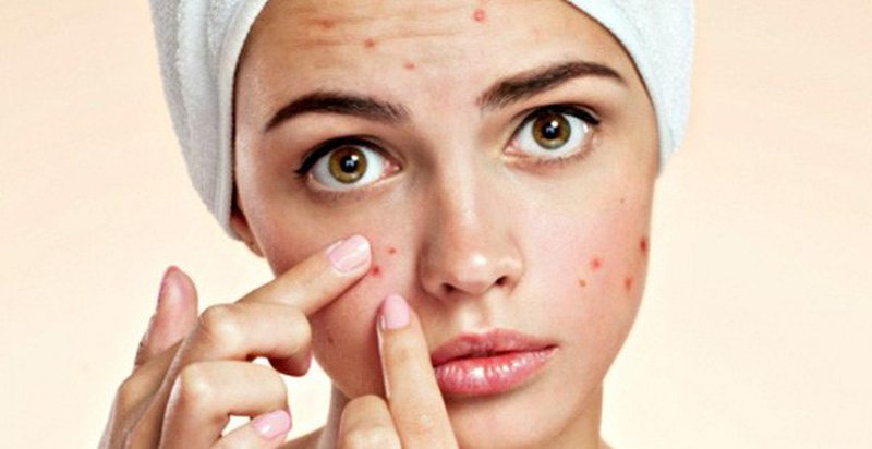 Mụn bọc ở má có nên nặn không