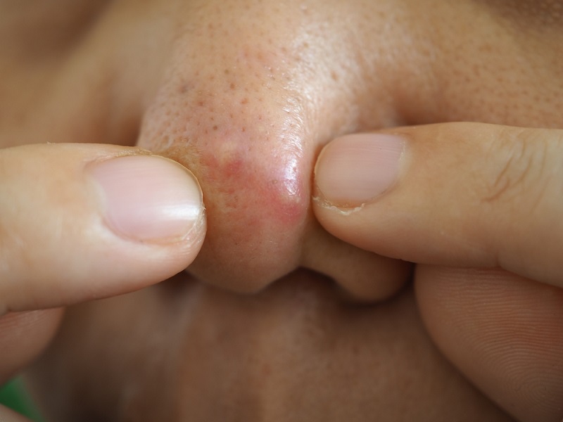 Mụn bọc ở mũi