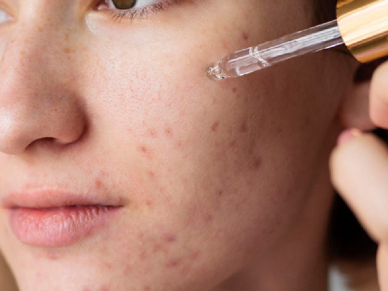 Điều trị mụn bọc ở mũi chuẩn y khoa