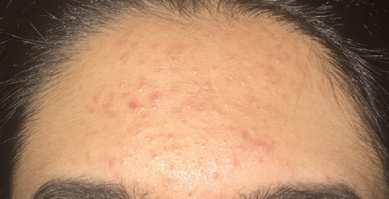 Mụn cám ở trán