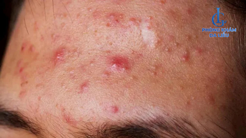 Nguyên nhân gây sẹo rỗ nặng