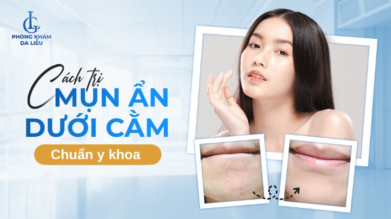 Mụn ẩn dưới cằm