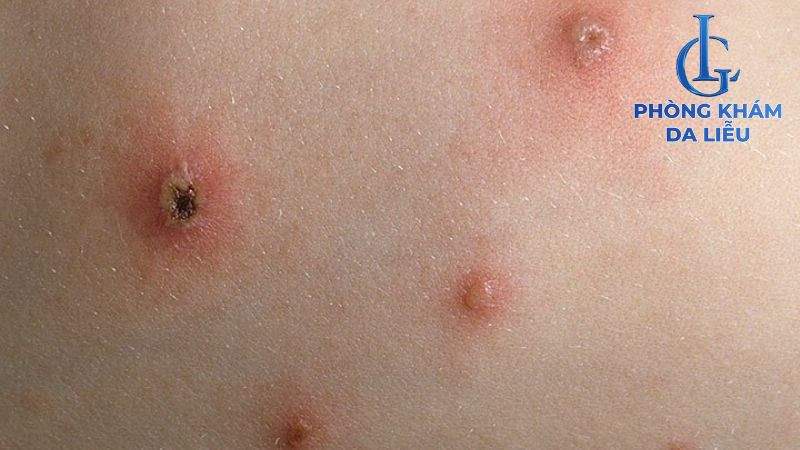 Nguyên nhân gây sẹo rỗ