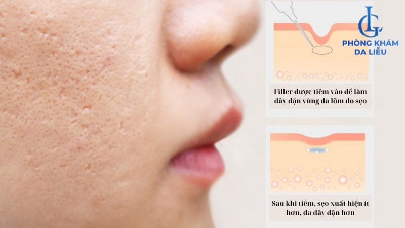 Điều trị sẹo rỗ nặng