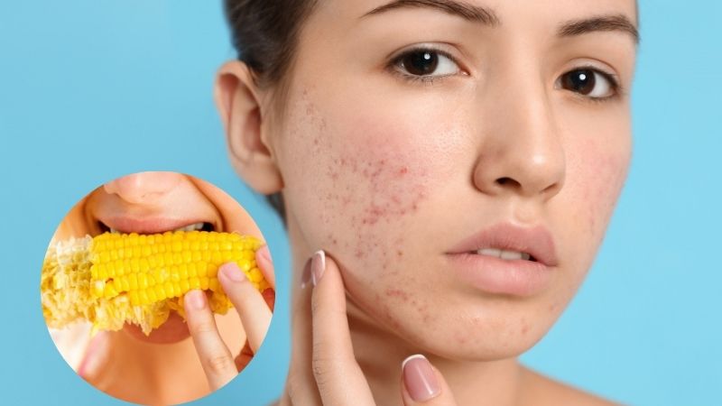 ăn bắp bị nổi mụn