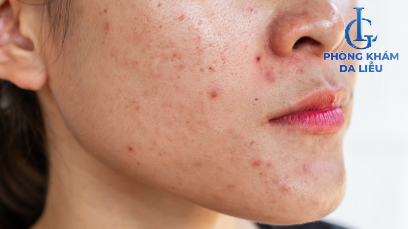 mặt bị mụn