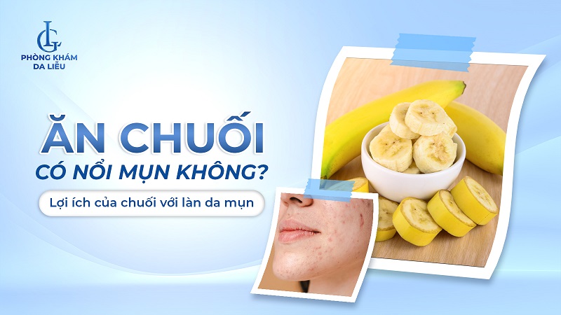 Ăn chuối có nổi mụn không