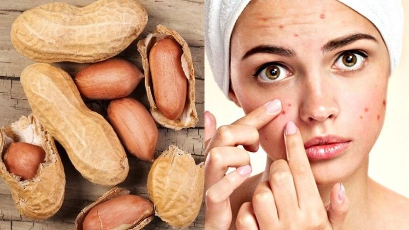 ăn đậu phộng bị nổi mụn
