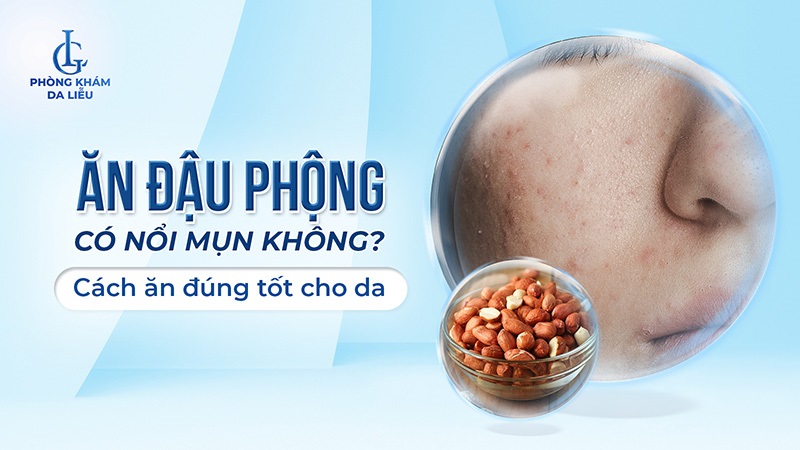 Ăn đậu phộng có nổi mụn không