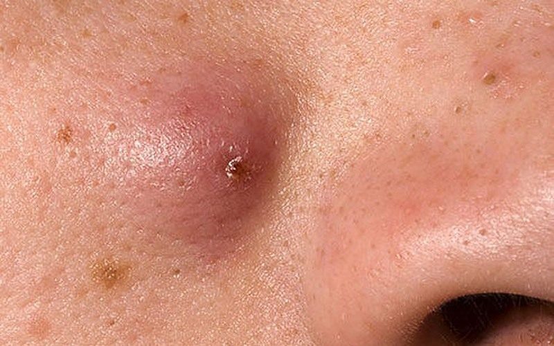 Mụn bọc chai cứng