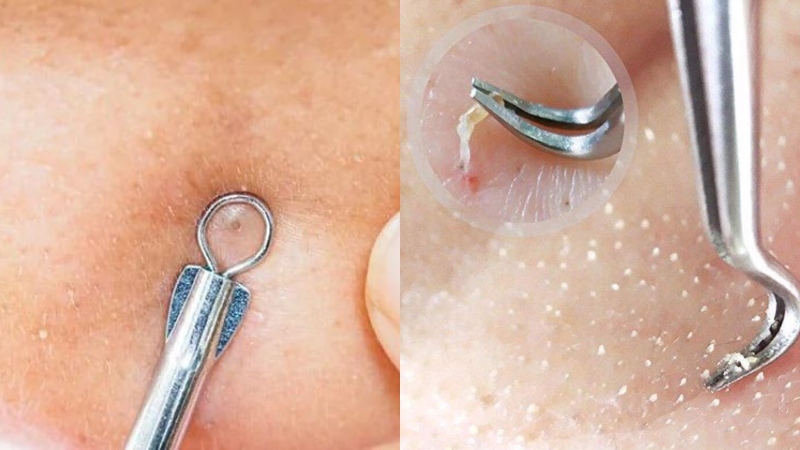 Cách nặn mụn đầu đen