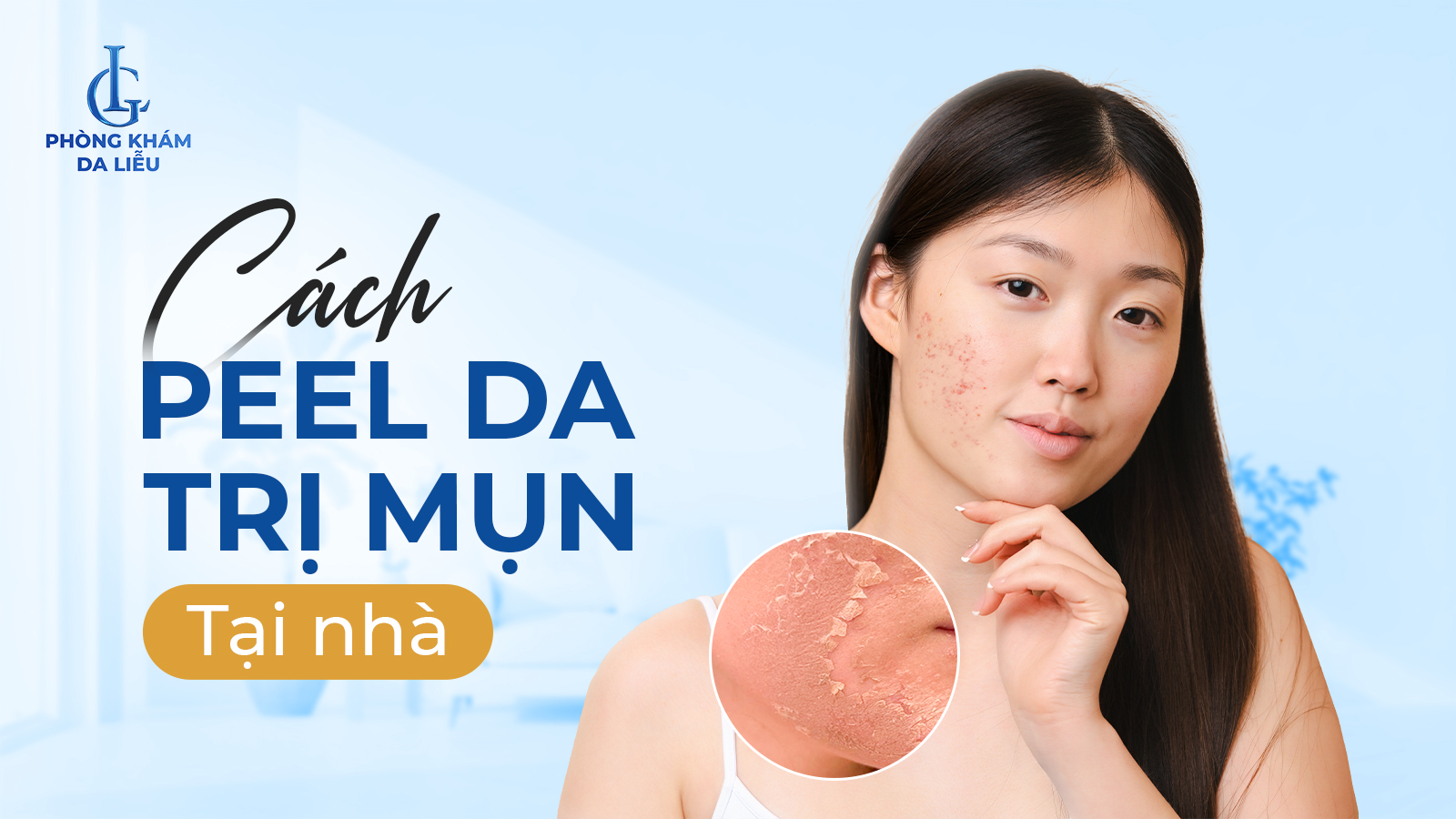 Peel da trị mụn tại nhà