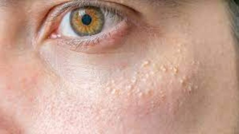 Mụn ẩn dưới mắt