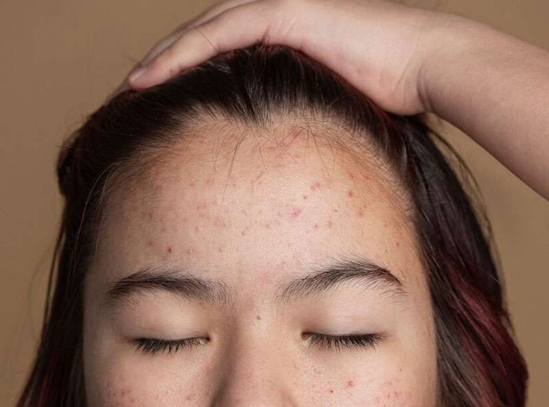 Mụn ẩn dưới da