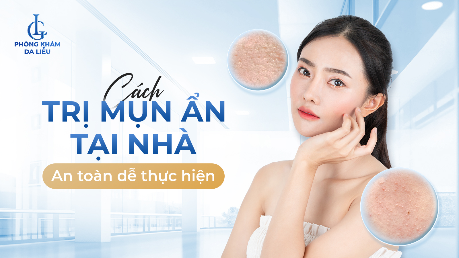 Cách trị mụn ẩn tại nhà