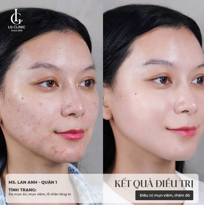 Điều trị mụn nội tiết