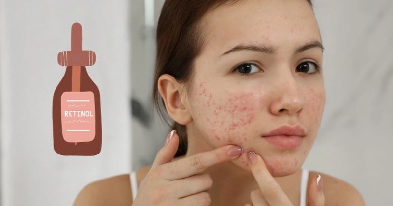 Điều trị mụn nội tiết