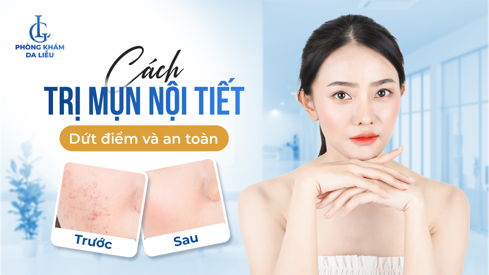 Cách trị mụn nội tiết dứt điểm