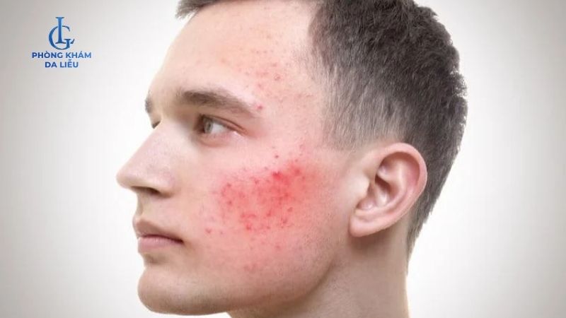 Có nên peel da sau khi nặn mụn