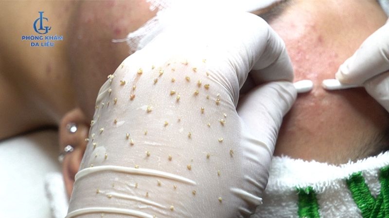 Có nên peel da sau khi nặn mụn