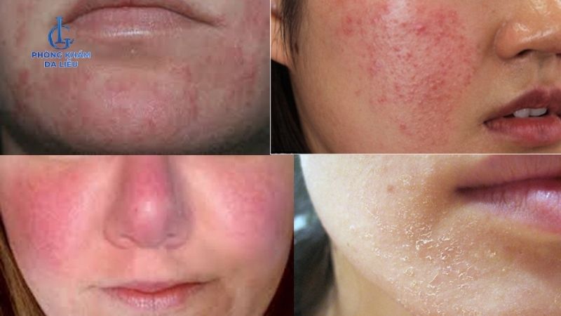 Có nên peel da sau khi nặn mụn