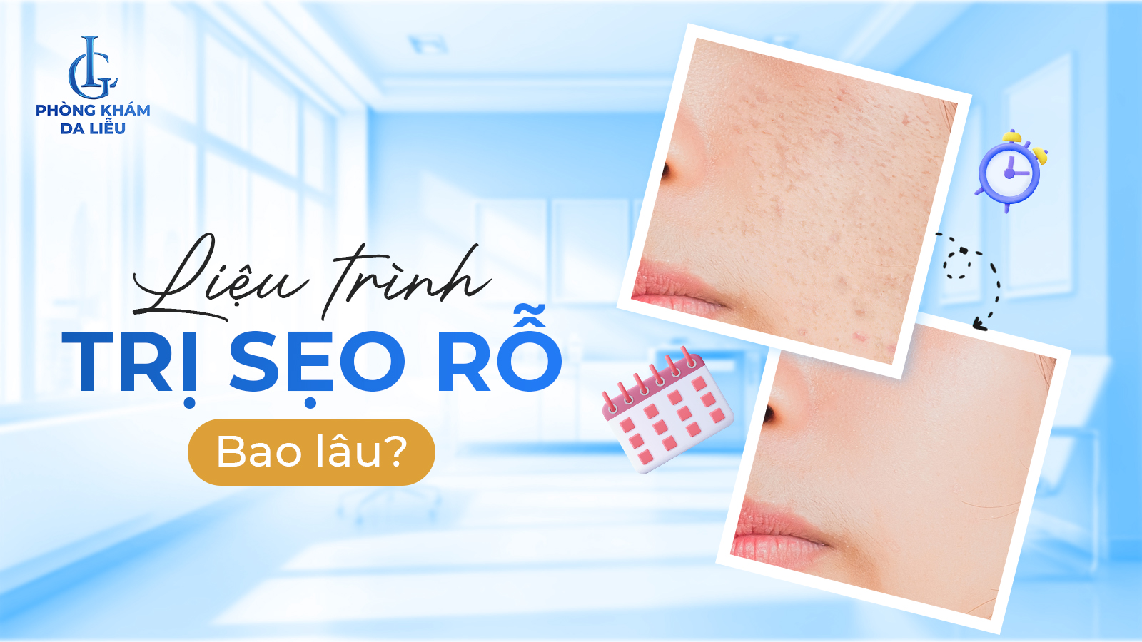 Liệu trình trị sẹo rỗ bao lâu