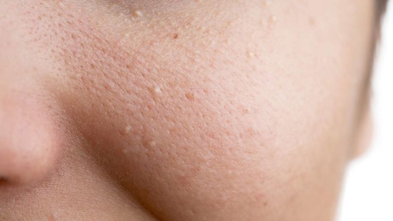 Mụn ẩn 2 bên má