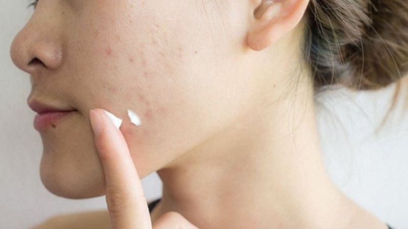 Bôi thuốc đặc trị mụn ẩn