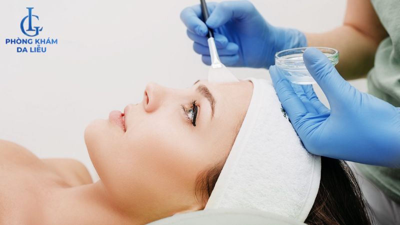 Mụn ẩn có peel da được không