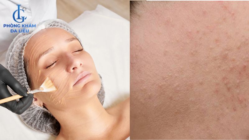 Peel da có trị mụn ẩn không​