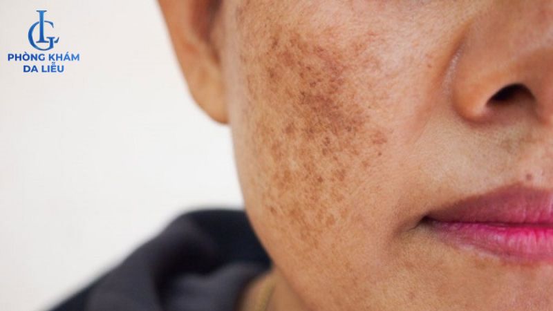 Mụn ẩn có peel da được không